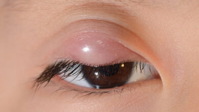 Photo of HOW TO TREAT PIMPLES ON EYE LID NATURALLY