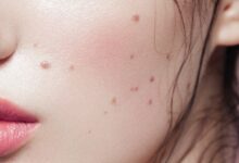 Photo of QUICK AND EASY REMEDY TO REMOVE MOLES AND WARTS