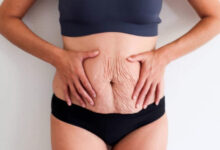 Photo of EFFECTIVE HOME REMEDIES FOR STRETCH MARKS