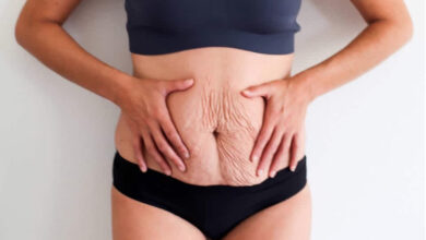 Photo of EFFECTIVE HOME REMEDIES FOR STRETCH MARKS