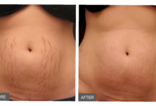 Photo of 8 SURE REMEDIES TO ELIMINATE STRETCH MARKS PERMANENTLY