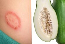 Photo of USE UNRIPE PAWPAW AND FORGET U HAD RINGWORM