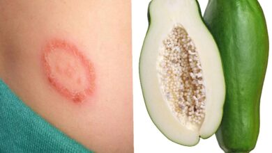 Photo of USE UNRIPE PAWPAW AND FORGET U HAD RINGWORM