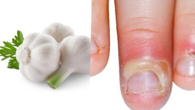 Photo of PERFECT GARLIC CLOVES REMEDY FOR WHITLOW