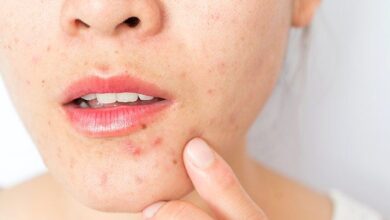Photo of 5 GREAT HOME REMEDIES FOR PIMPLES AND PROBLEMATIC SKIN