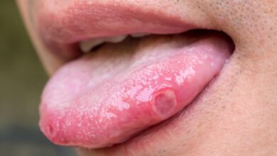 Photo of HOME REMEDIES FOR SORE OR TONGUE BLISTERS