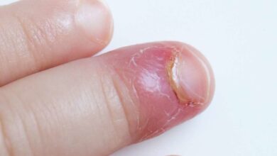 Photo of NAILS INFECTIONS CAUSES AND PREVENTIONS