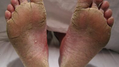 Photo of HOW TO COMBAT FOOT FUNGUS IN 1 WEEK