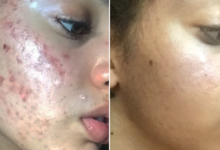 Photo of 10 BEST WAYS TO ELIMINATE PIMPLES IN A WEEK