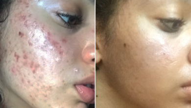 Photo of 10 BEST WAYS TO ELIMINATE PIMPLES IN A WEEK