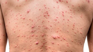 Photo of WAYS OF CLEARING CHIKEN POX IN 3DAYS