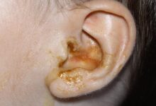 Photo of TIPS ON THE CAUSES AND PREVENTIONS OF EAR PUS