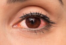 Photo of HOW TO PREVENT OR TREAT RED EYE