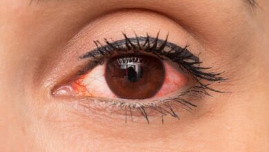 Photo of HOW TO PREVENT OR TREAT RED EYE
