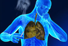 Photo of CAUSES AND PREVENTION OF TUBERCULOSIS