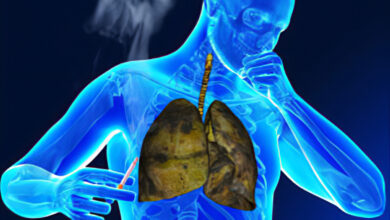 Photo of CAUSES AND PREVENTION OF TUBERCULOSIS