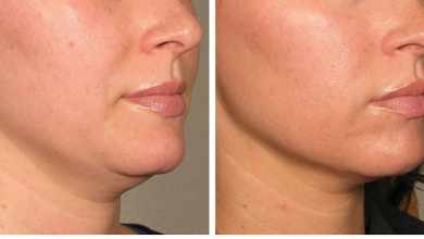 Photo of Everything You Need to Know About Laser Skin Tightening