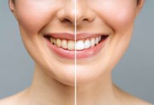 Photo of Do teeth whitening strips work?