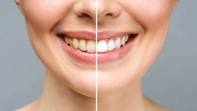 Photo of Do teeth whitening strips work?