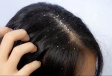Photo of The Science Behind Anti-Dandruff Shampoos — What Every Indian Should Know Before Buying
